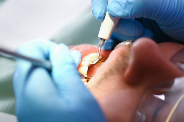Teeth Whitening in MT